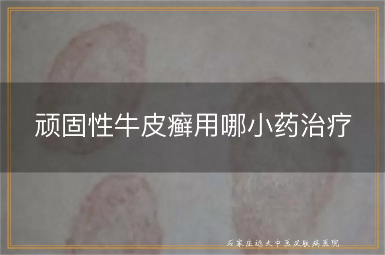 顽固性牛皮癣用哪小药治疗