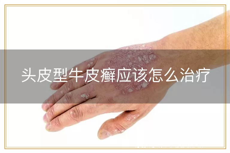 头皮型牛皮癣应该怎么治疗