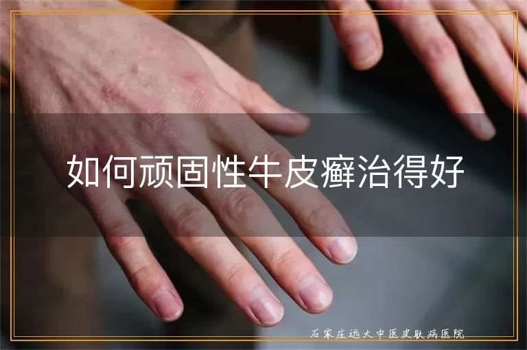 如何顽固性牛皮癣治得好