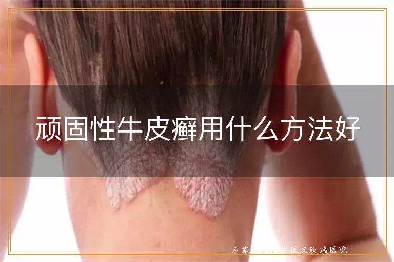 顽固性牛皮癣用什么方法好