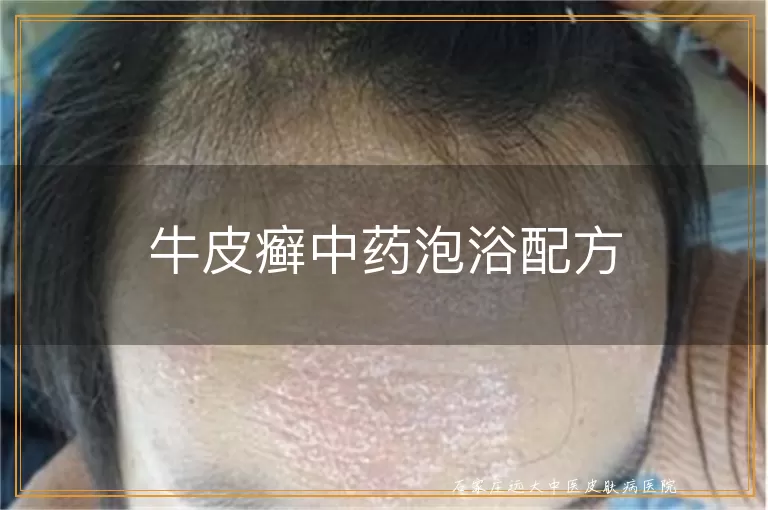 牛皮癣中药泡浴配方
