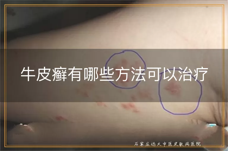 牛皮癣有哪些方法可以治疗