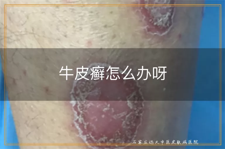 牛皮癣怎么办呀