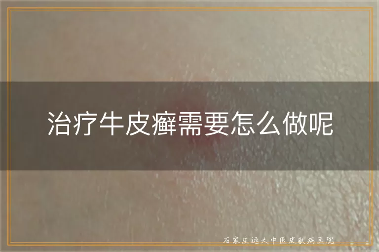 治疗牛皮癣需要怎么做呢