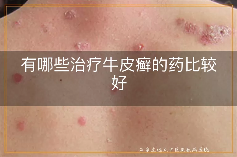 有哪些治疗牛皮癣的药比较好