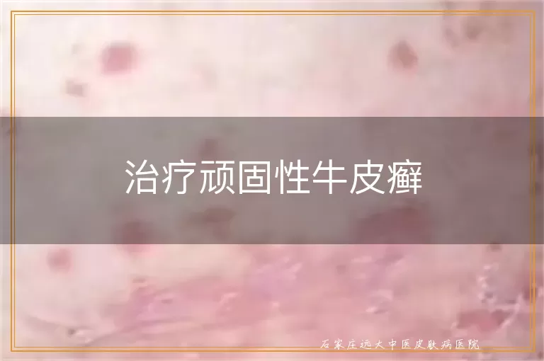 治疗顽固性牛皮癣