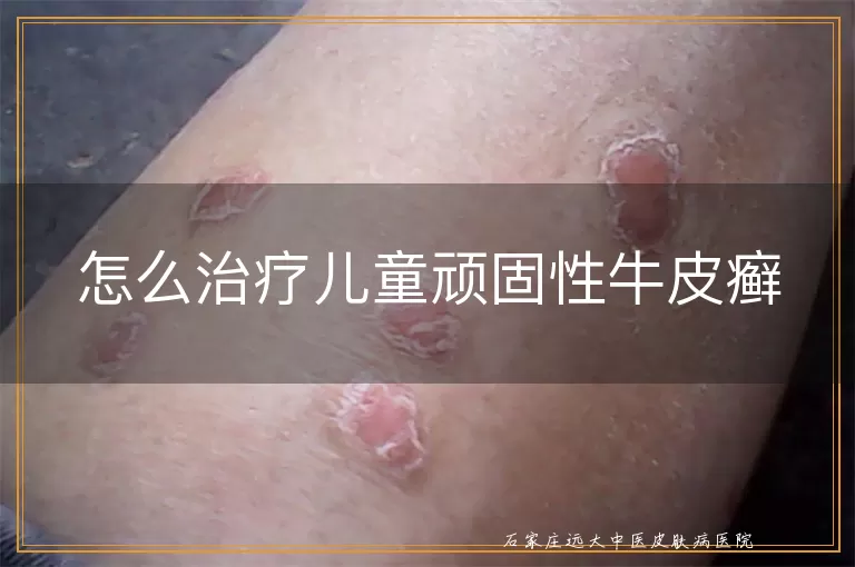 怎么治疗儿童顽固性牛皮癣