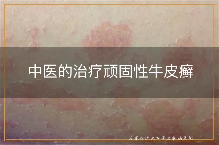 中医的治疗顽固性牛皮癣