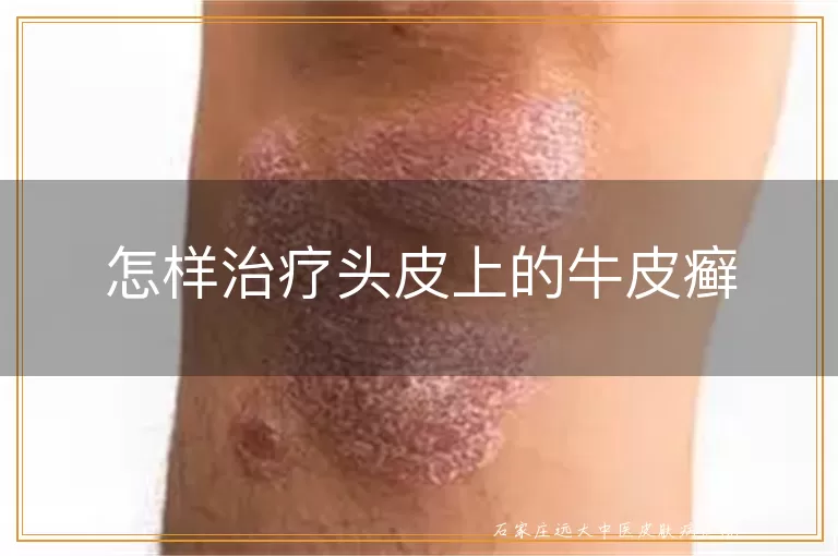 怎样治疗头皮上的牛皮癣