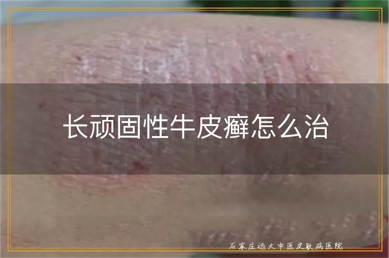 长顽固性牛皮癣怎么治