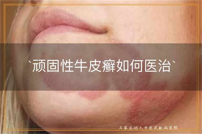 顽固性牛皮癣如何医治