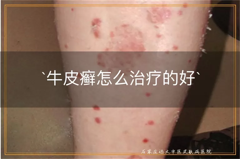 牛皮癣怎么治疗的好