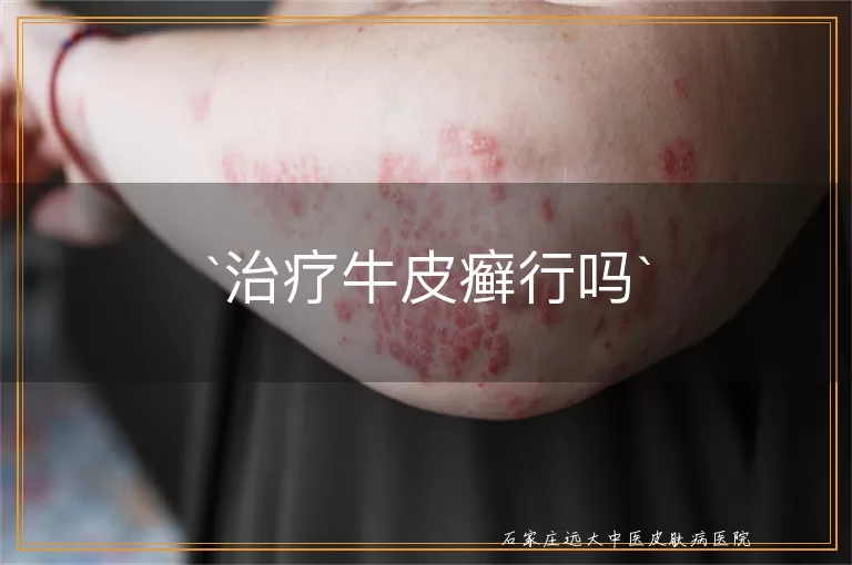 治疗牛皮癣行吗