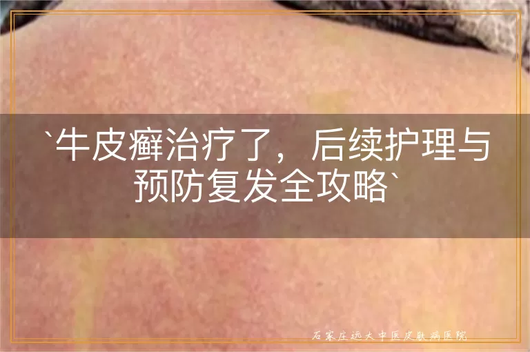 牛皮癣治疗了，后续护理与预防复发全攻略