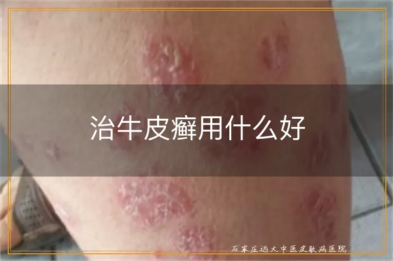 治牛皮癣用什么好