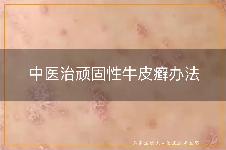 中医治顽固性牛皮癣办法