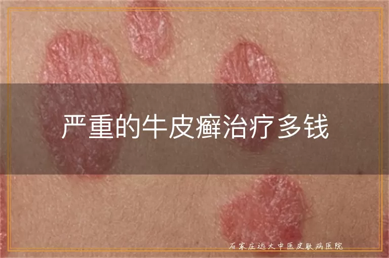 严重的牛皮癣治疗多钱