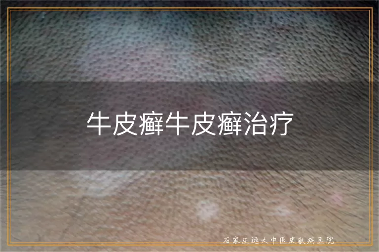 牛皮癣牛皮癣治疗