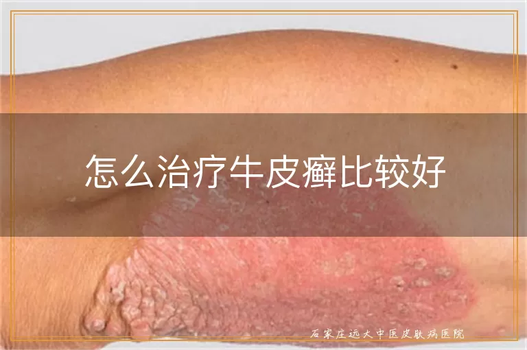 怎么治疗牛皮癣比较好