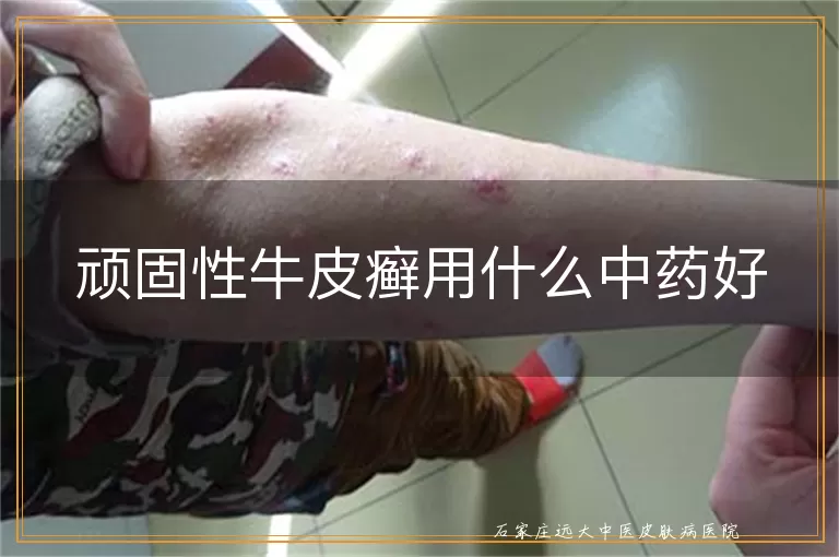 顽固性牛皮癣用什么中药好