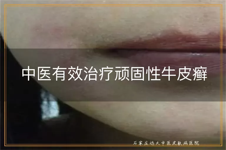中医有效治疗顽固性牛皮癣