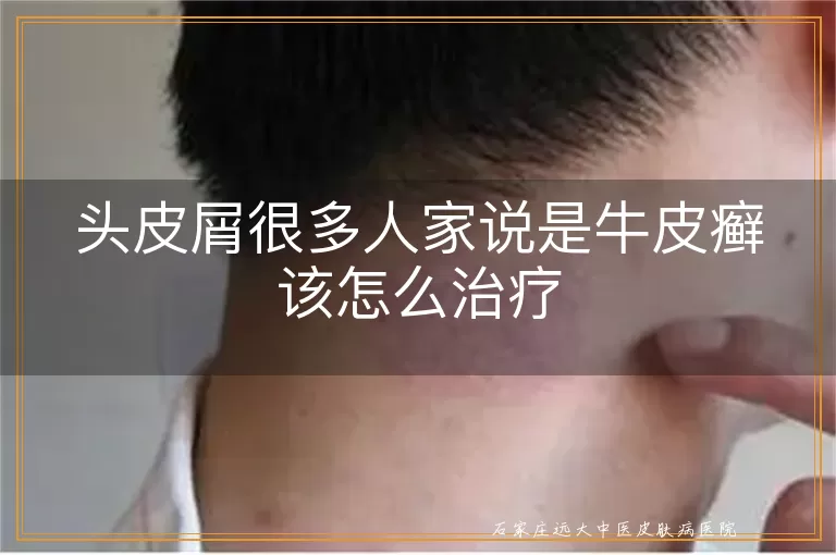 头皮屑很多人家说是牛皮癣该怎么治疗