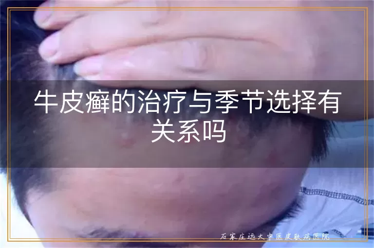 牛皮癣的治疗与季节选择有关系吗