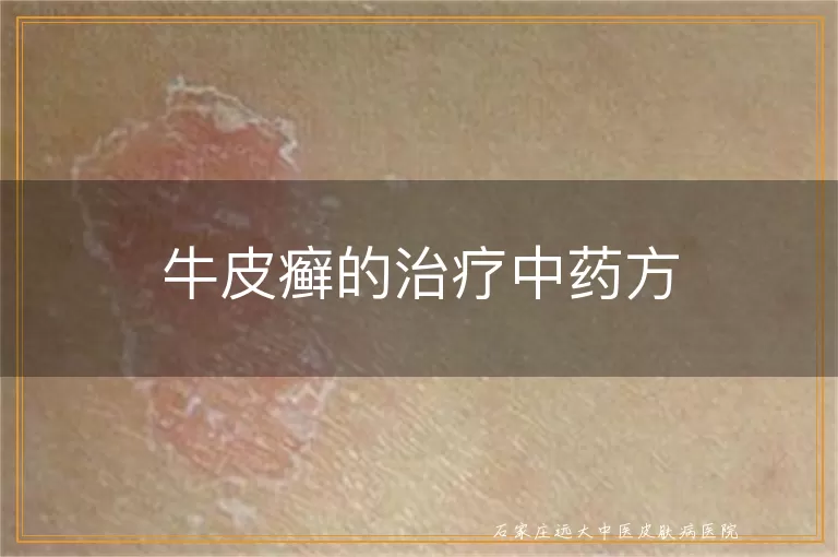 牛皮癣的治疗中药方