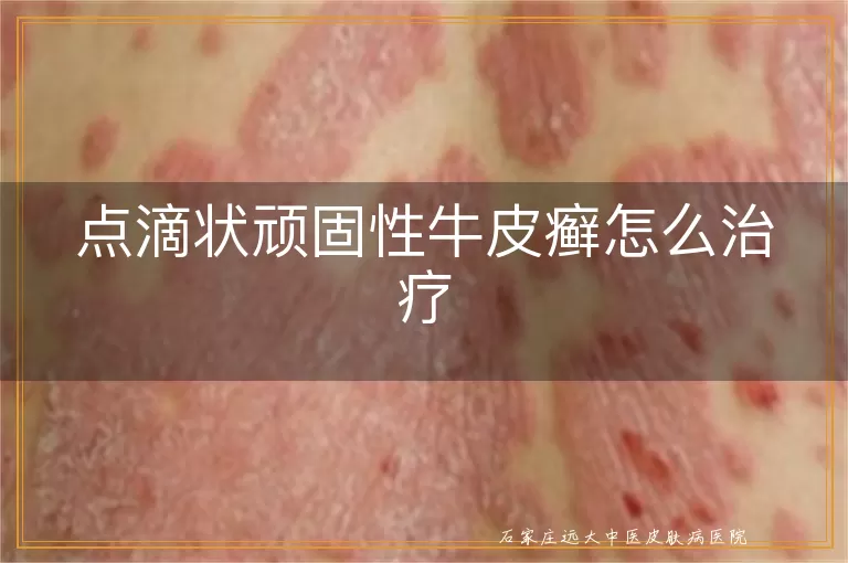 点滴状顽固性牛皮癣怎么治疗