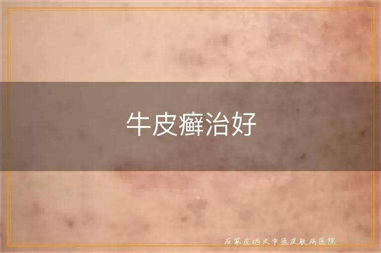 牛皮癣治好