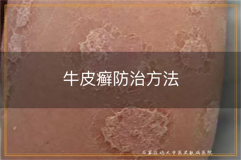 牛皮癣防治方法
