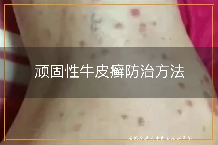 顽固性牛皮癣防治方法