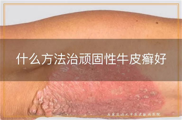什么方法治顽固性牛皮癣好