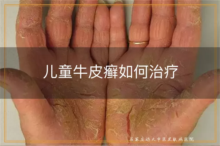 儿童牛皮癣如何治疗