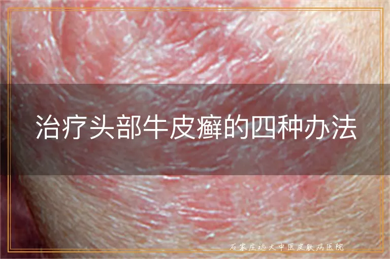 治疗头部牛皮癣的四种办法