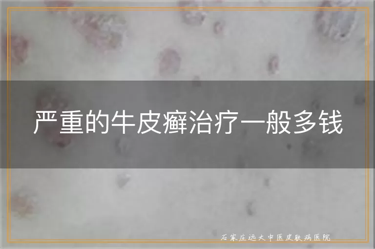 严重的牛皮癣治疗一般多钱