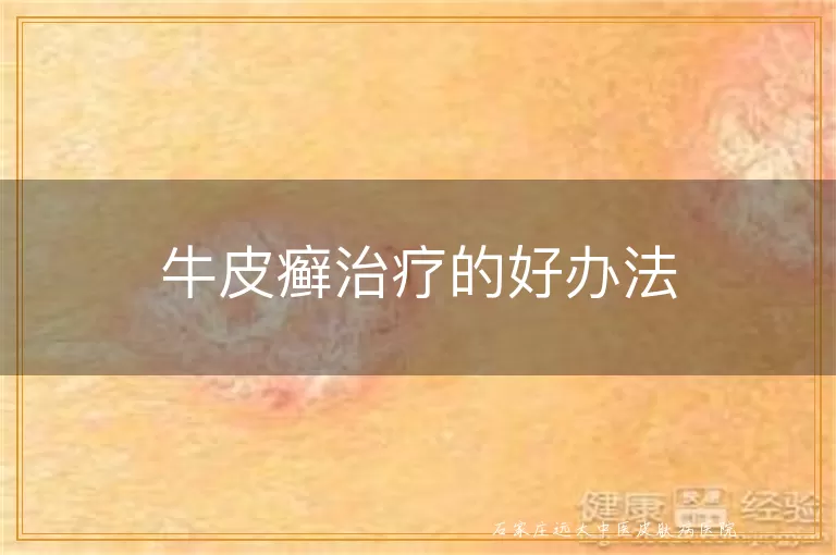 牛皮癣治疗的好办法