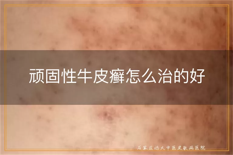 顽固性牛皮癣怎么治的好