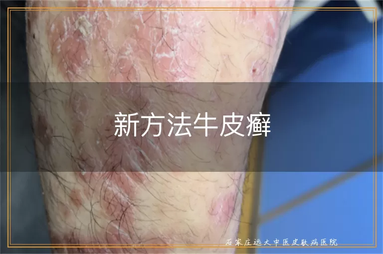 新方法牛皮癣