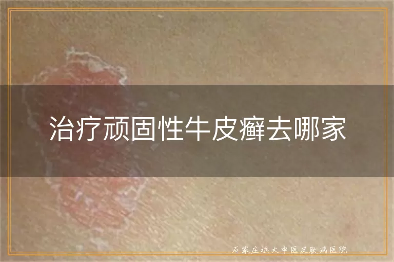 治疗顽固性牛皮癣去哪家