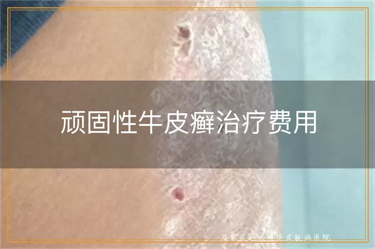 顽固性牛皮癣治疗费用