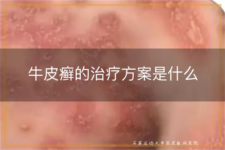 牛皮癣的治疗方案是什么