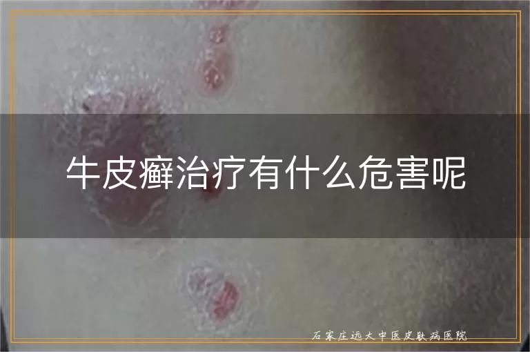 牛皮癣治疗有什么危害呢