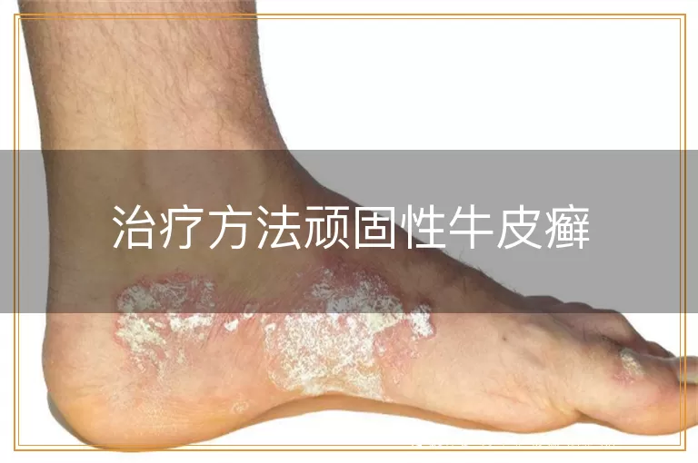 治疗方法顽固性牛皮癣