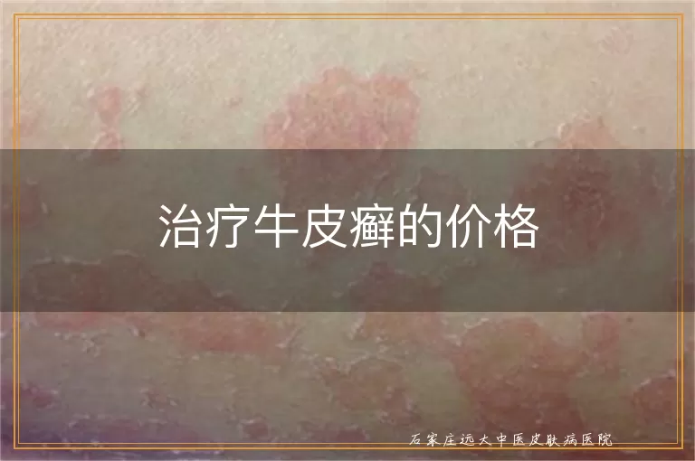 治疗牛皮癣的价格