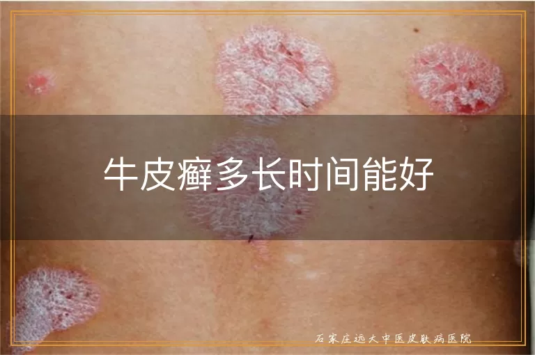 牛皮癣多长时间能好