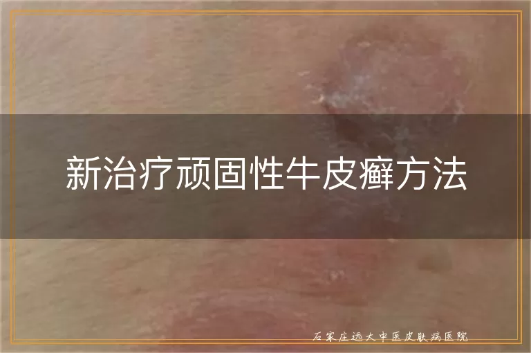新治疗顽固性牛皮癣方法
