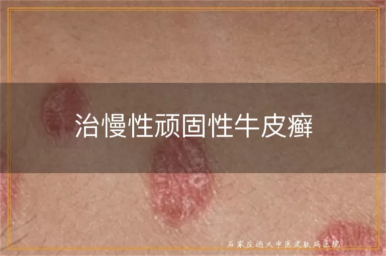 治慢性顽固性牛皮癣
