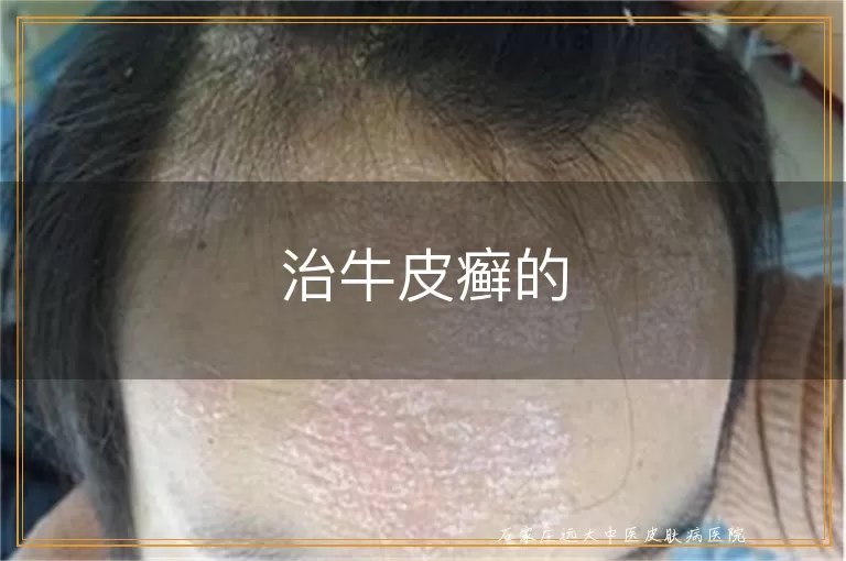 治牛皮癣的