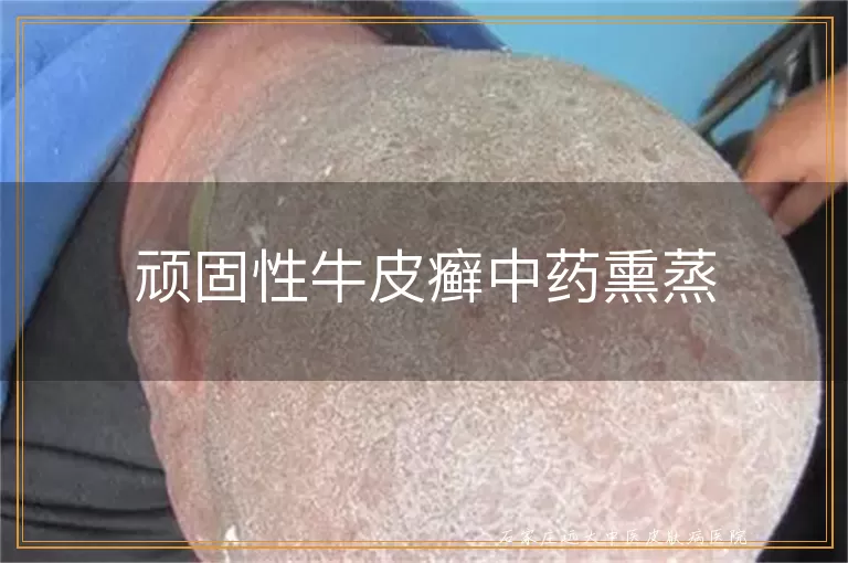 顽固性牛皮癣中药熏蒸